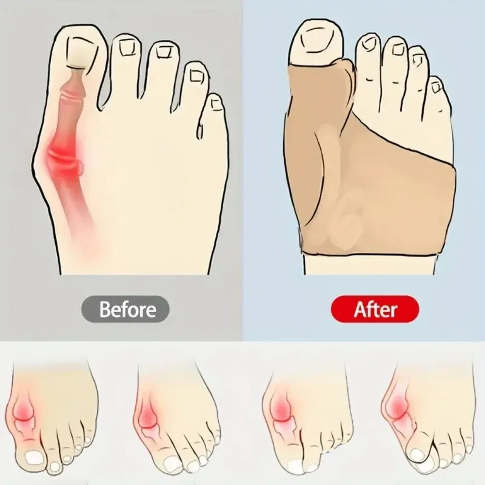 1Pair Toe Separator Hallux Valgus Bunion Corrector Hammer Toe Straightener Foot Pain Relief Orthopedic Pedicure Tools Foot Care