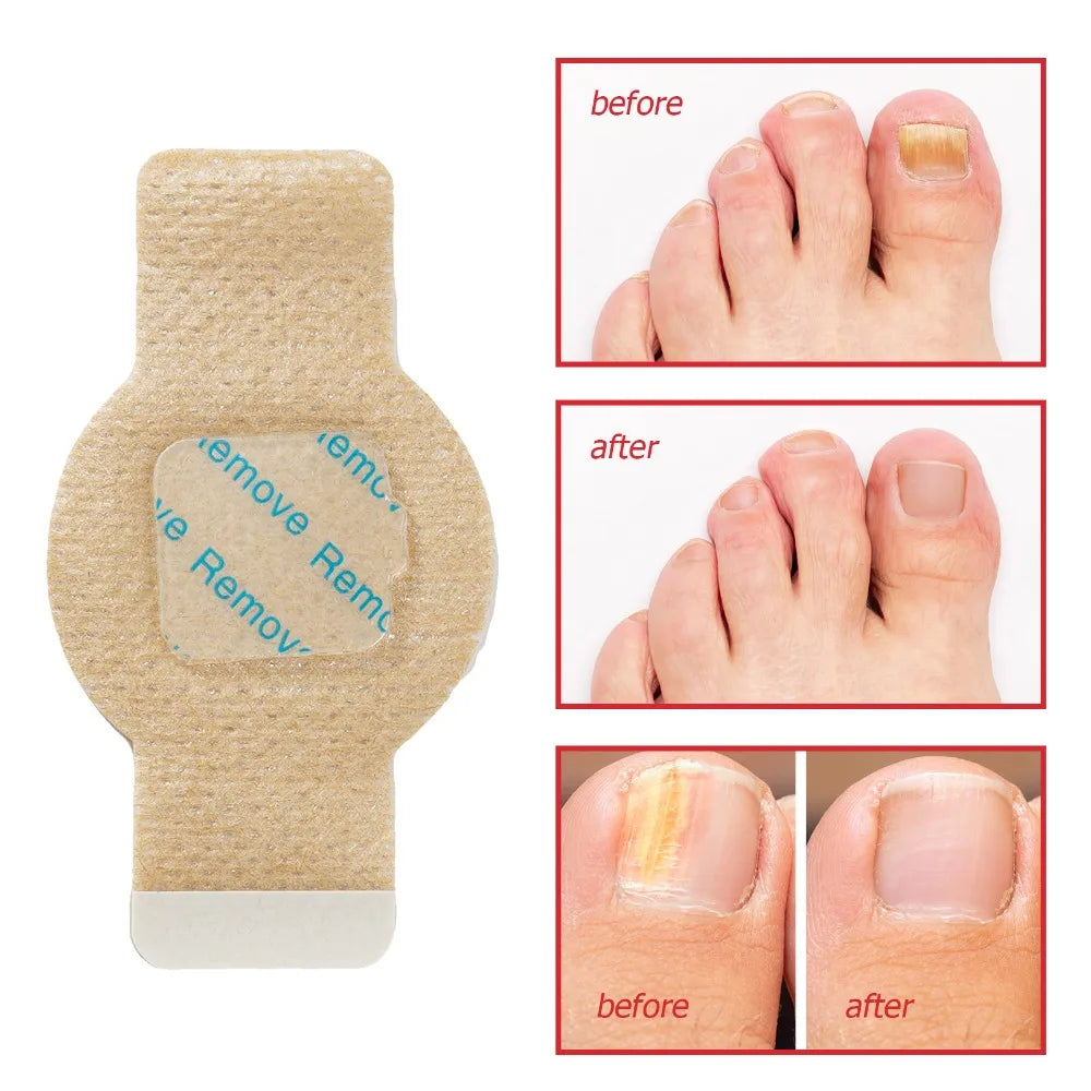 21Pcs Toenail Fungus Patch Waterproof Nail Repair Patches Nail Ingrown Correction Sticker Discolored Damaged Nail Foot Care Tool