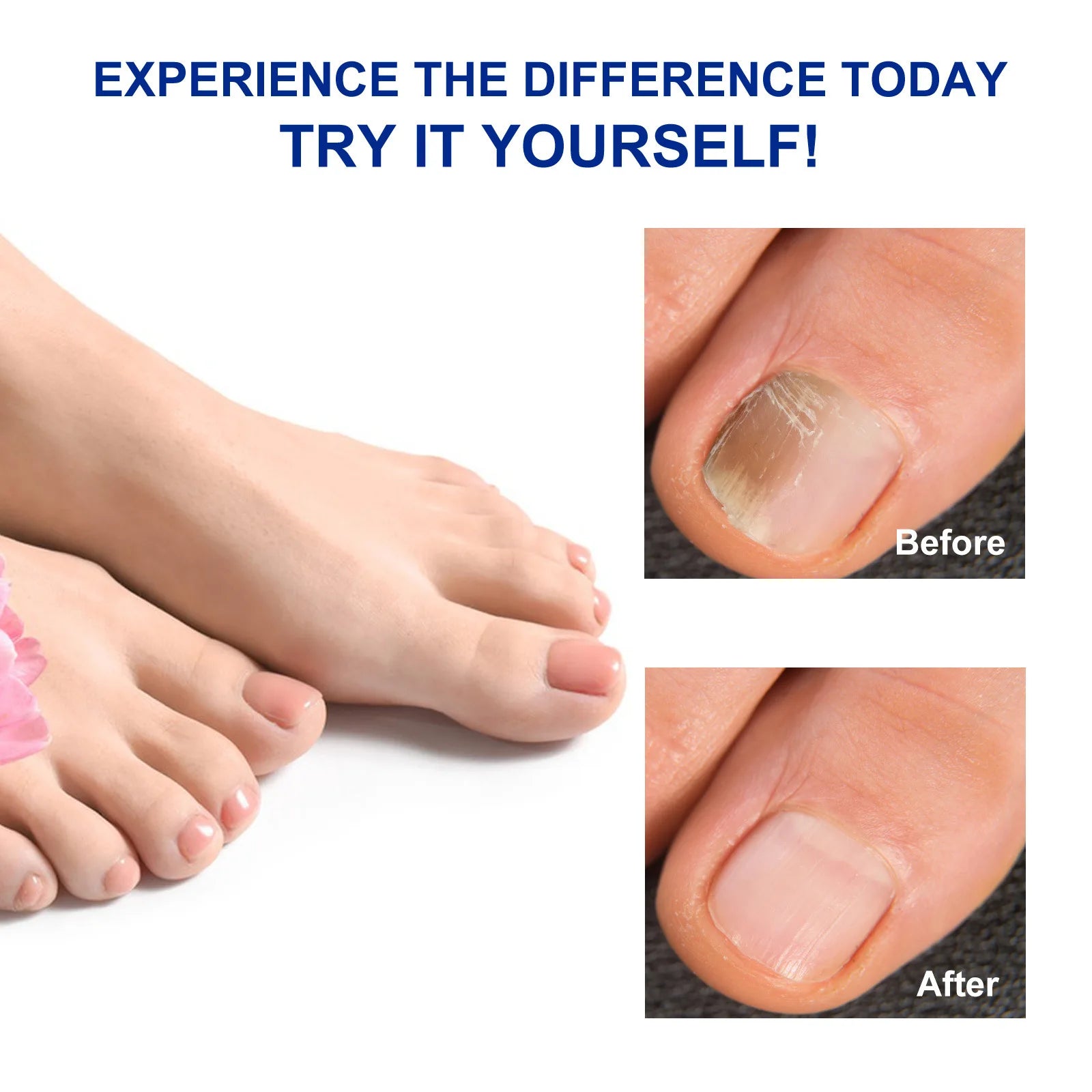 32Pc Toenail Patches Nail Repair Extra Strength Patches For Toenail Fingernail Non-Irritating And Breathable Nail Repair Renewal