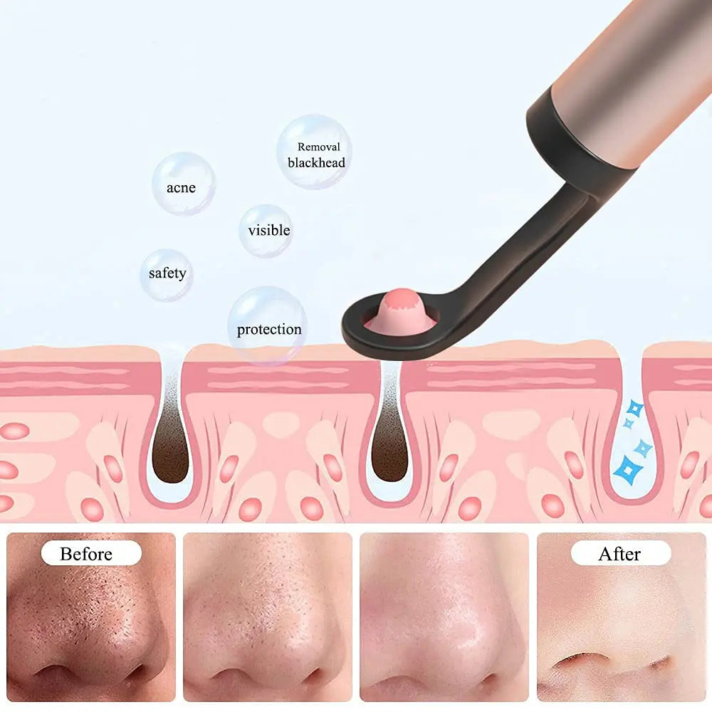 T15 Smart Visual Earwax Acne 2 in 1 Removal Tool With HD1080P Camera Ear Otoscope Cleaner IP67 Waterproof Endoscope